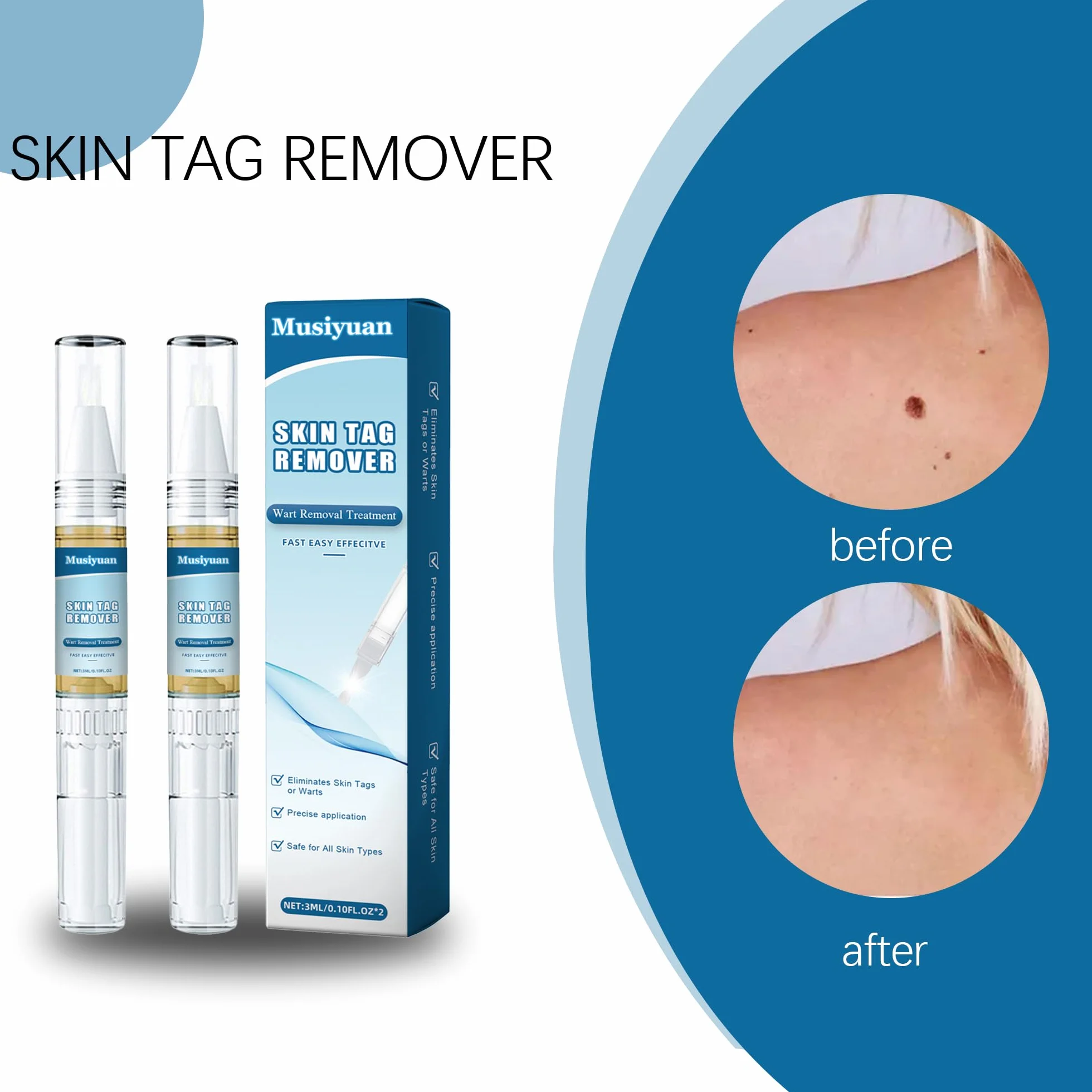 Kit removedor de verrugas para cuerpo y manos, paquete de 2