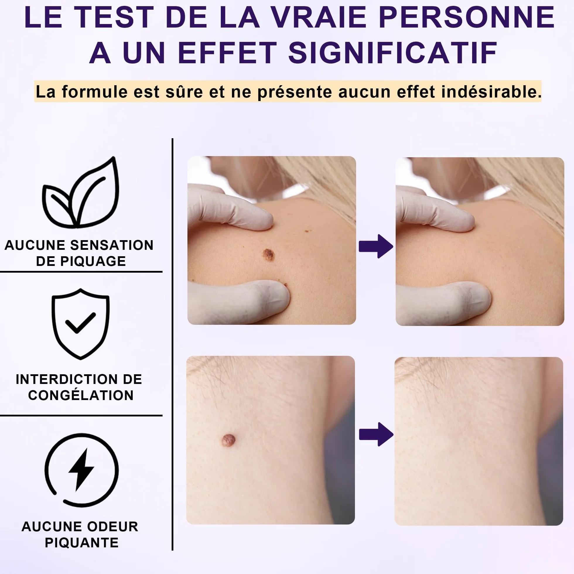 Crema eliminar verrugas 20g para verrugas plantares