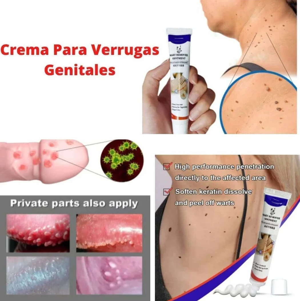 Remover Wart Ointment Genital Vulva Condyloma Acuminatum Treatment Cream Plantar (2pcs)