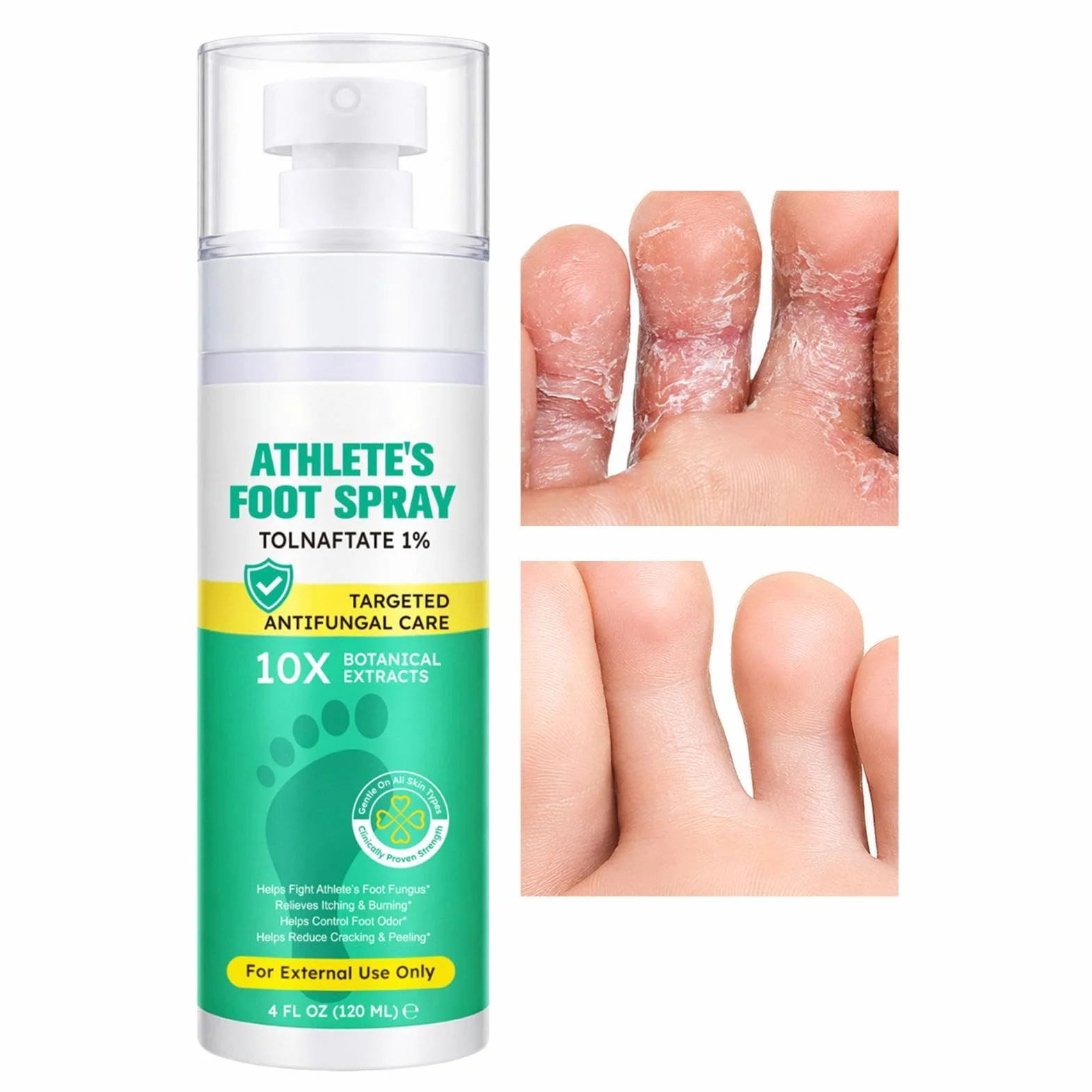 Spray para pies de atletas 120 ml calmante antipicazón cuidado de los pies