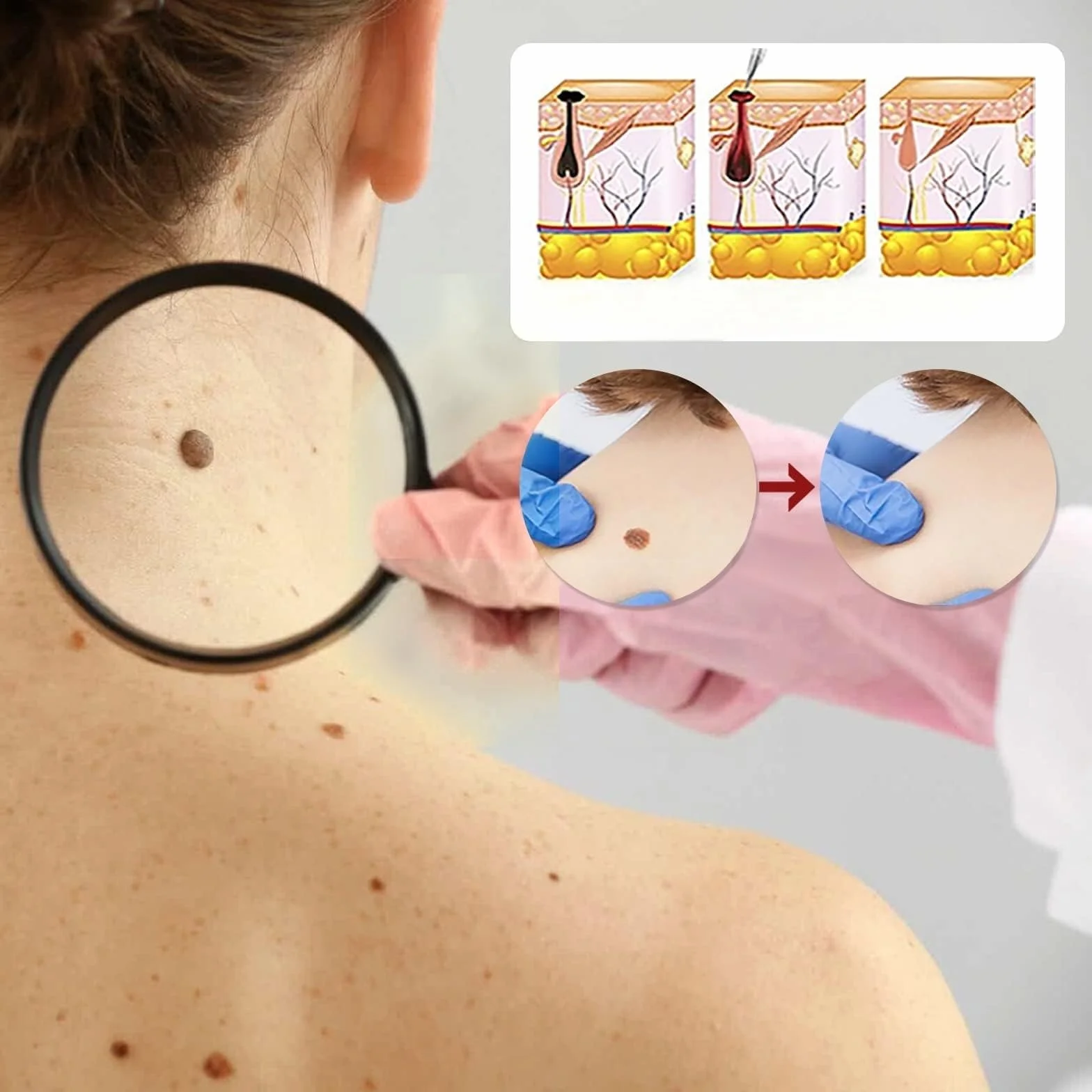 Eliminador de acrocordones Pipeta de precisión 10 ml para rostro y cuerpo