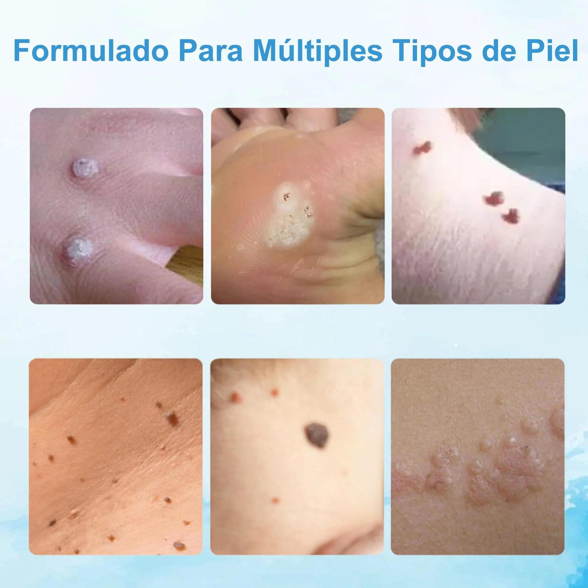 Crema para verrugas y acrocordones 20g Elimina verrugas comunes plantares callos