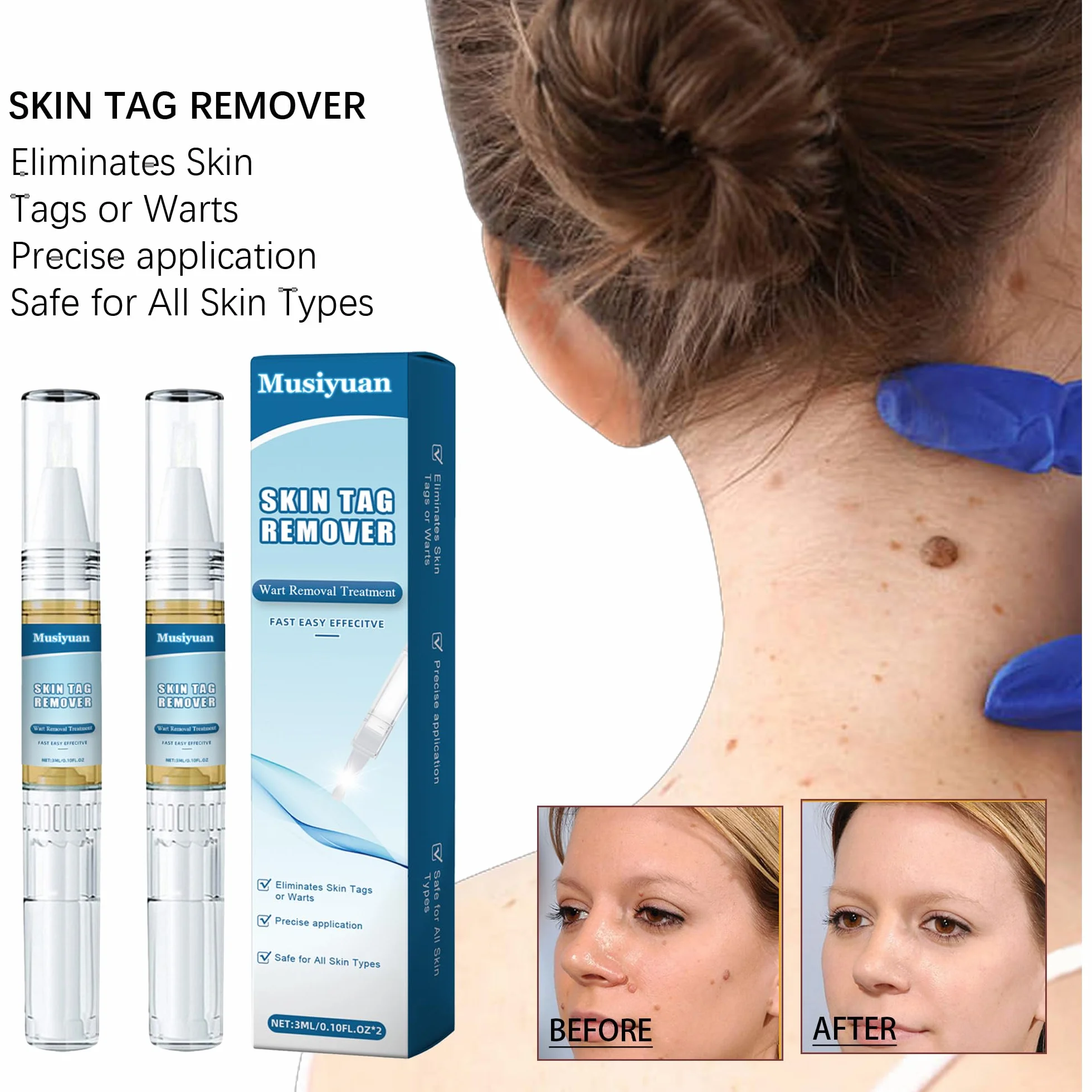 Kit removedor de verrugas para cuerpo y manos, paquete de 2