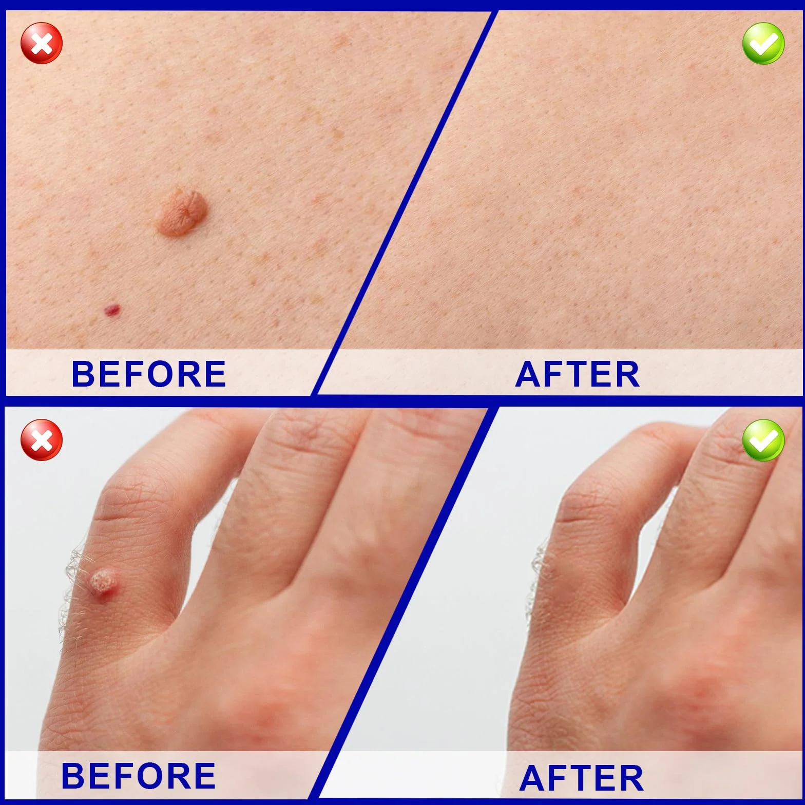 Suavemente Skin Tag Remover 30ml Quitar Verrugas Comunes Fórmula Suave