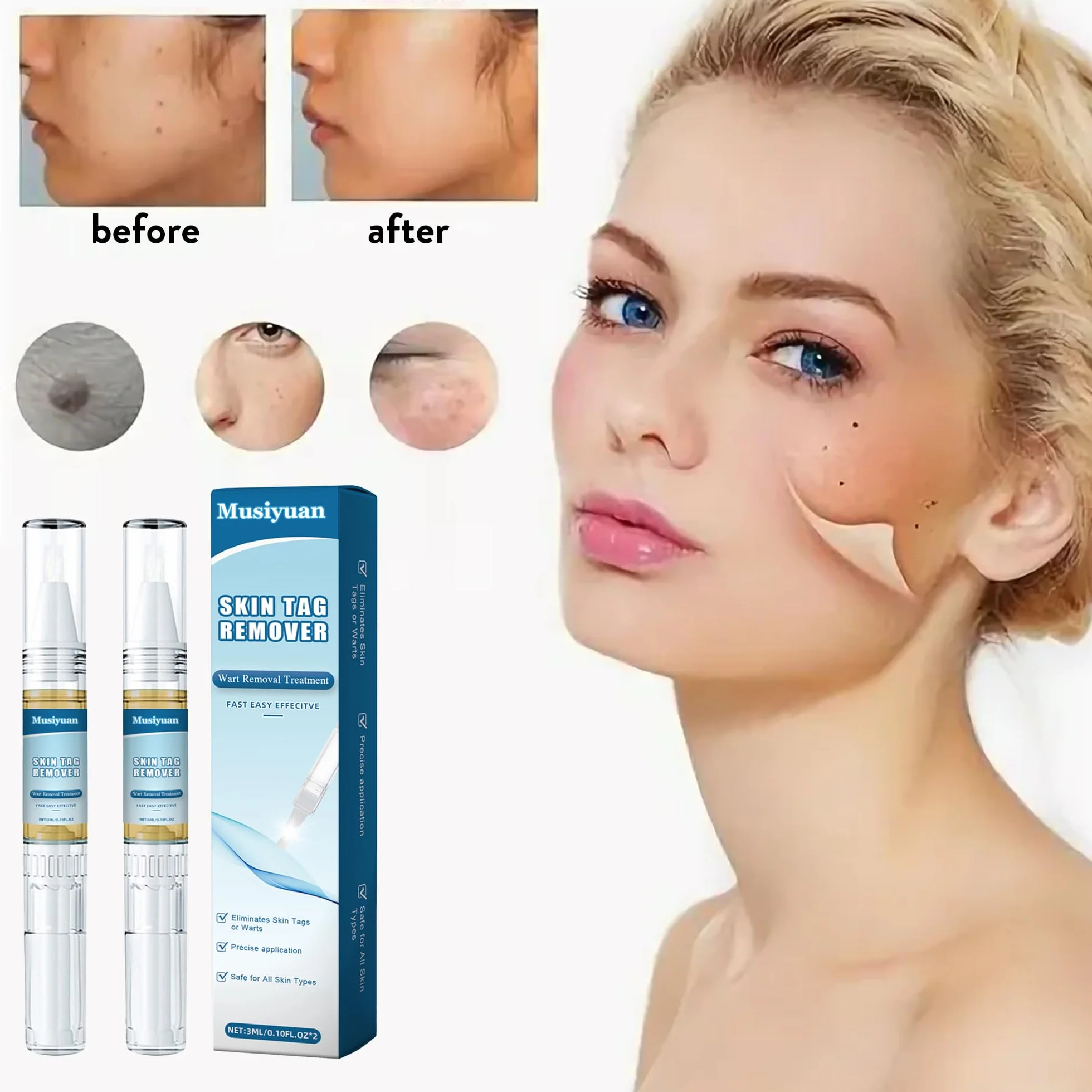 Kit removedor de verrugas para cuerpo y manos, paquete de 2