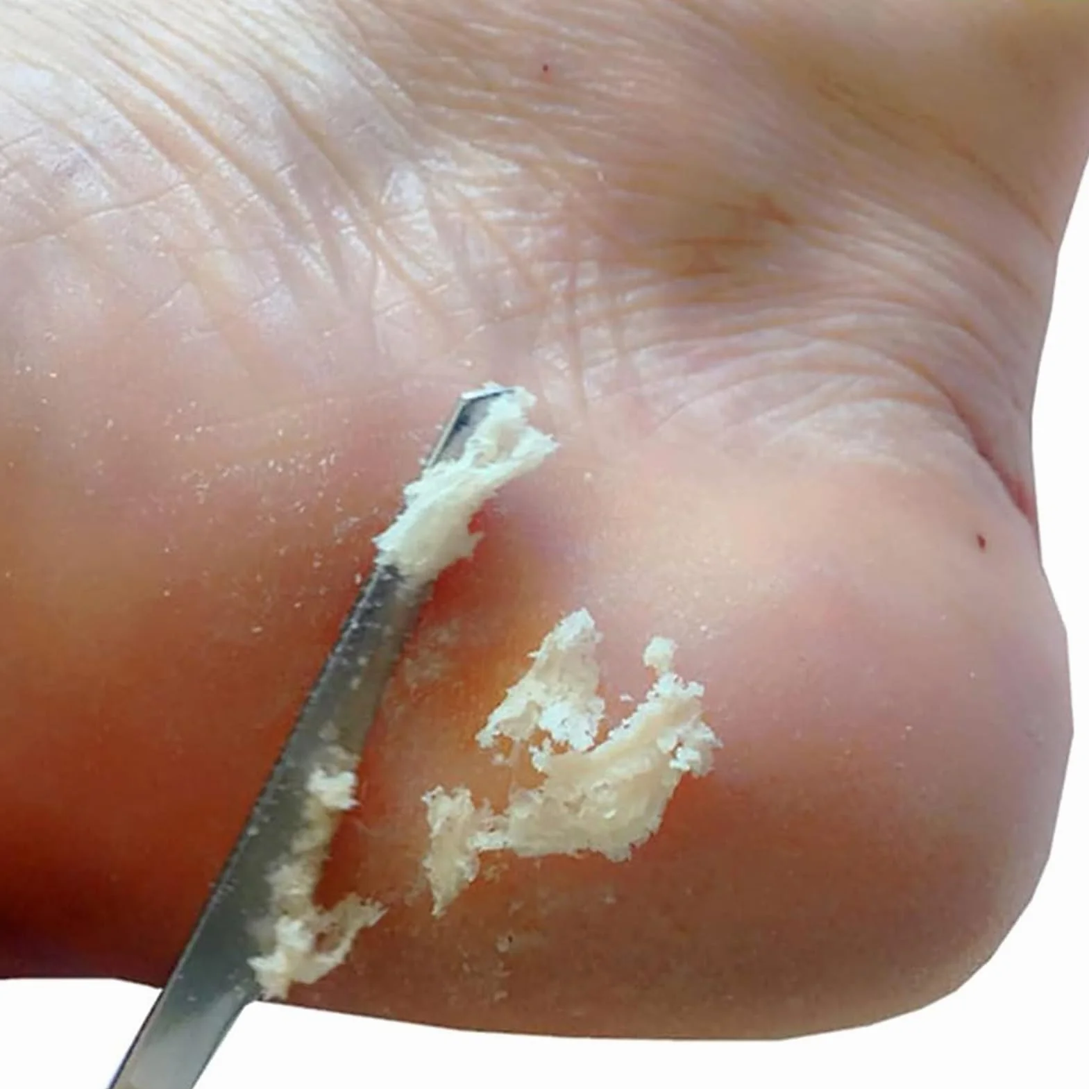 Eliminador de callos para pies - Herramienta de lijado manual, exfoliador de piel gruesa y limpiador portátil