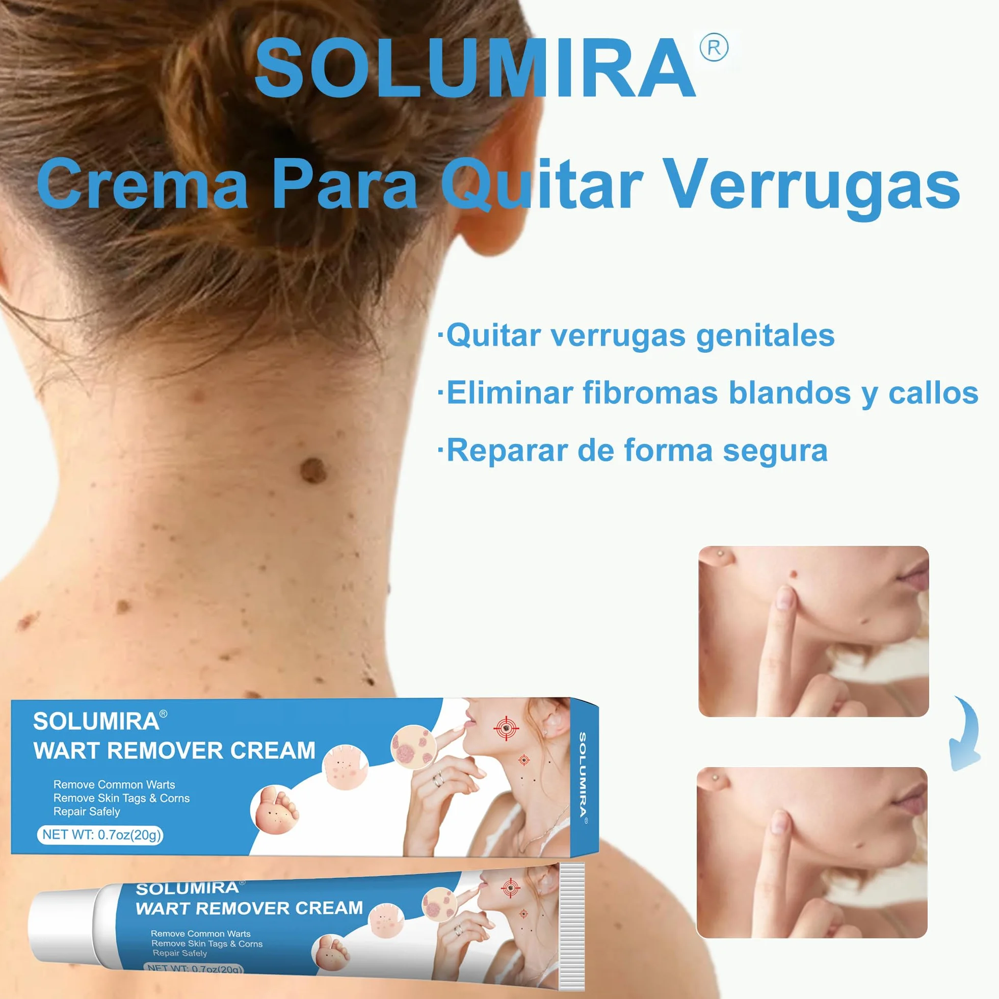 Crema para verrugas y acrocordones 20g Elimina verrugas comunes plantares callos