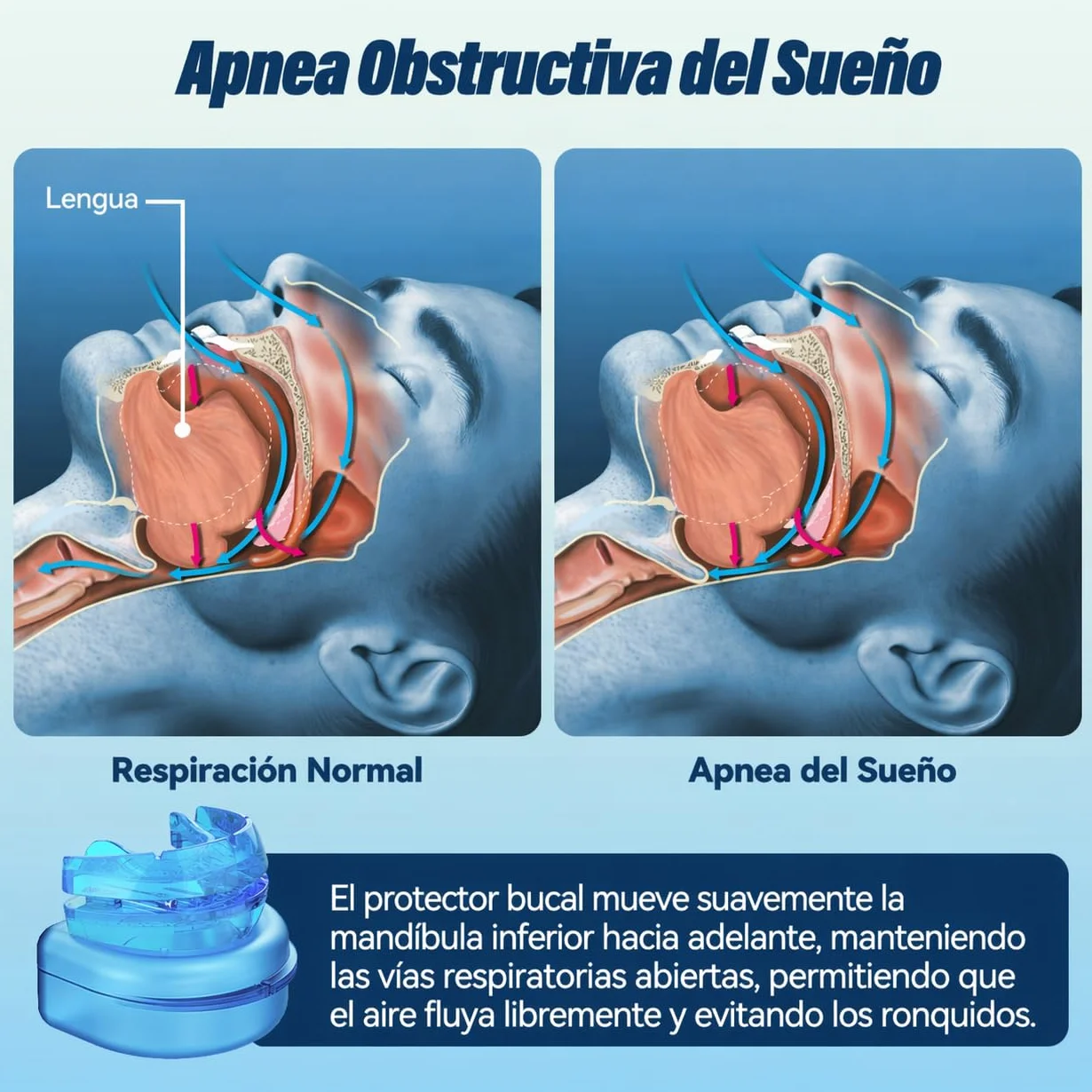 Dispositivo Antironquidos Ajustable Férula Anti Ronquidos para Dormir Mejora del Descanso