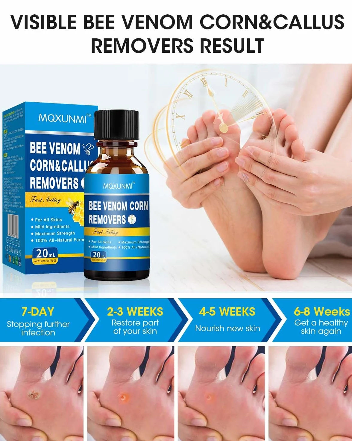 Removedor de Maíz con Veneno de Abeja 20 ml Máxima Potencia Eliminador de Callos Líquido para Pies