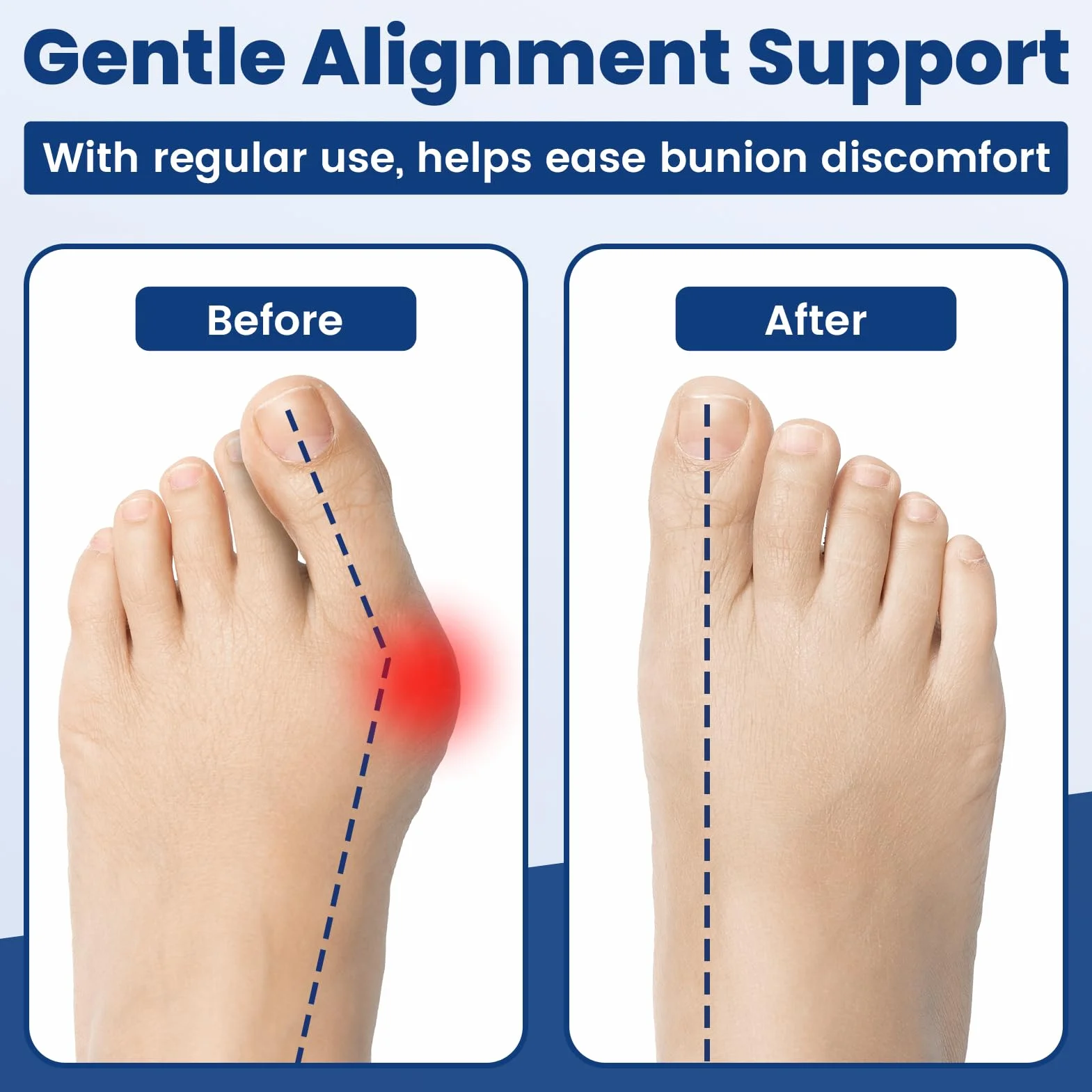 Bandas de Entrenamiento para Hallux Valgus Pack de 3, Enderezador de Dedos para Corrección de Juanetes y Alivio del Dolor