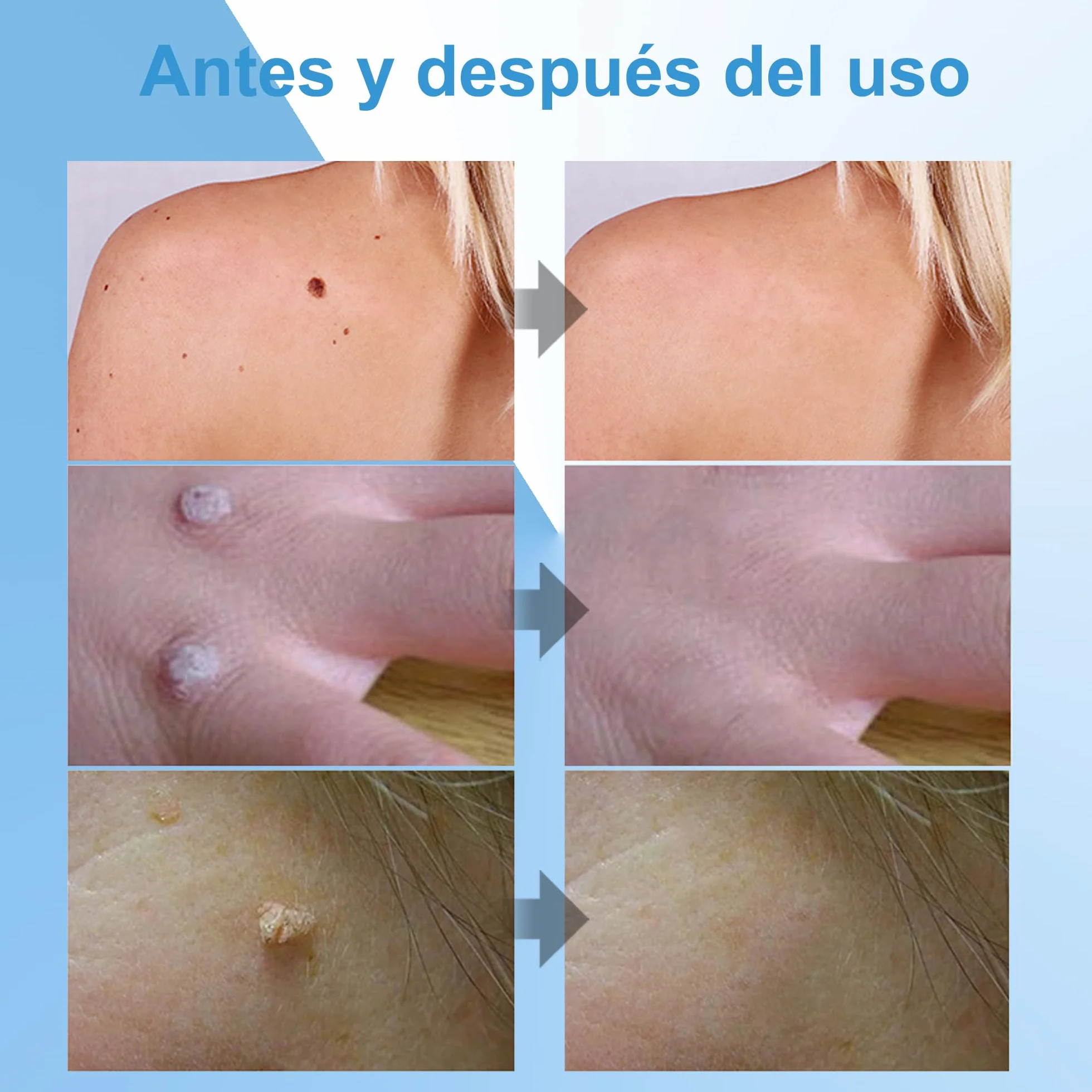 Crema para verrugas y acrocordones 20g Elimina verrugas comunes plantares callos