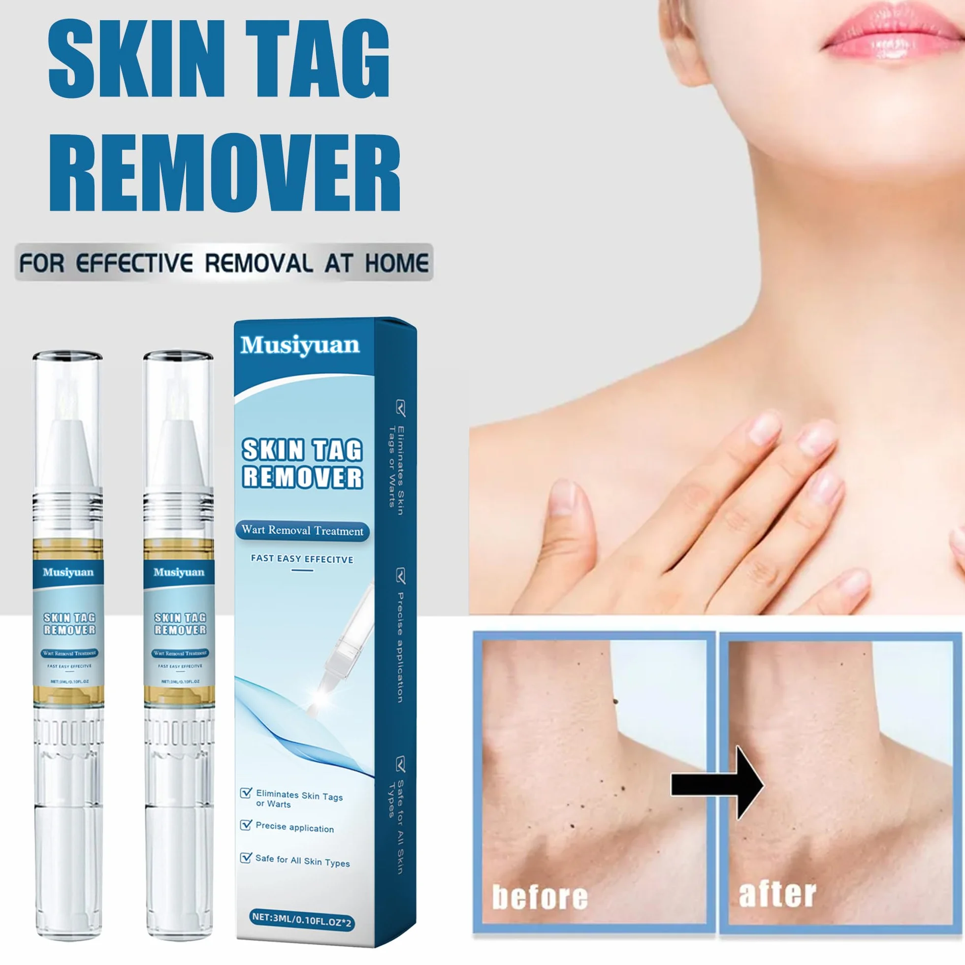 Kit removedor de verrugas para cuerpo y manos, paquete de 2