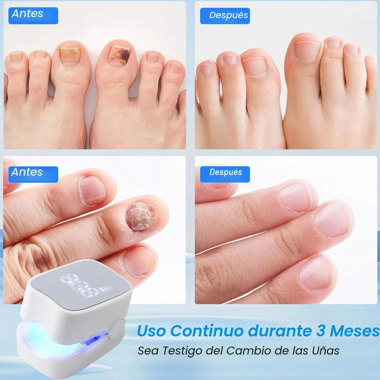 Láser para hongos de las uñas 7 minutos indicador de tiempo tratamiento rápido efectivo
