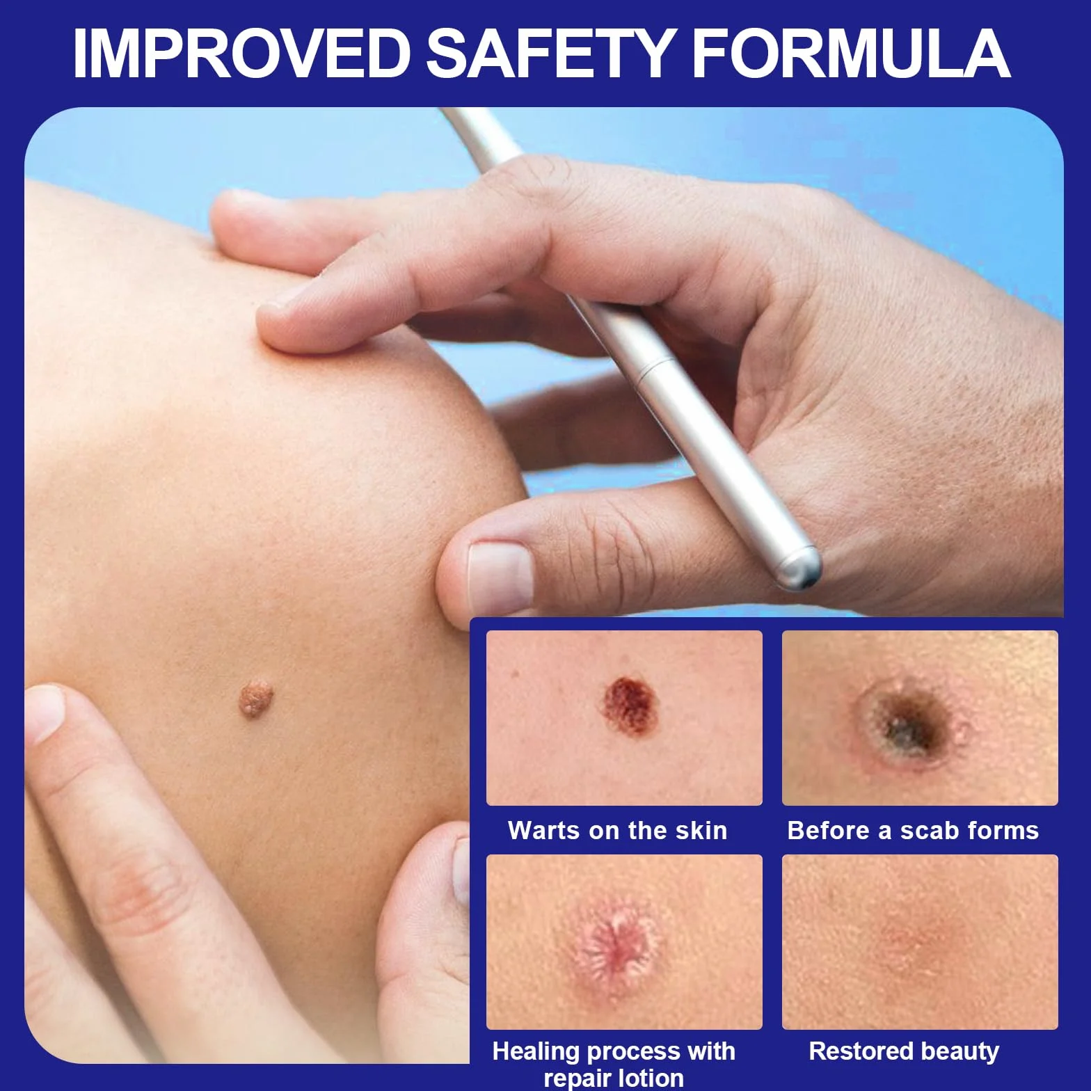 Suavemente Skin Tag Remover 30ml Quitar Verrugas Comunes Fórmula Suave