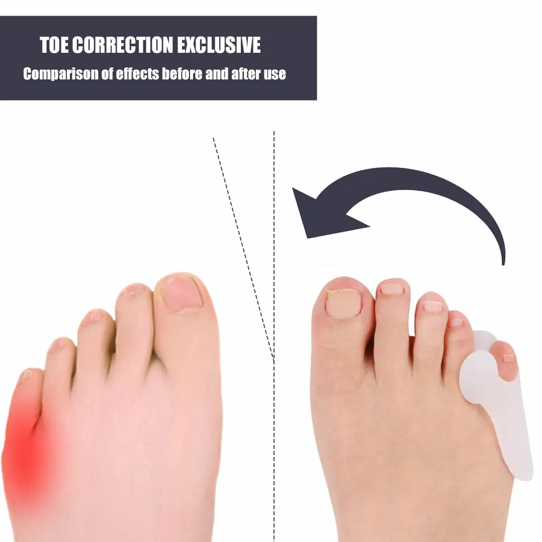 Corrector de Dedo pequeño de Silicona y Gel, 6 Unidades, para Hombres y Mujeres