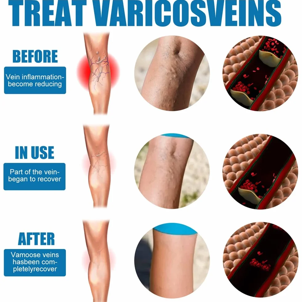 Spray Calmante para Venas Varicosas, Tratamiento de Varices, Alivio Dolor Pierna Circulación Sanguínea