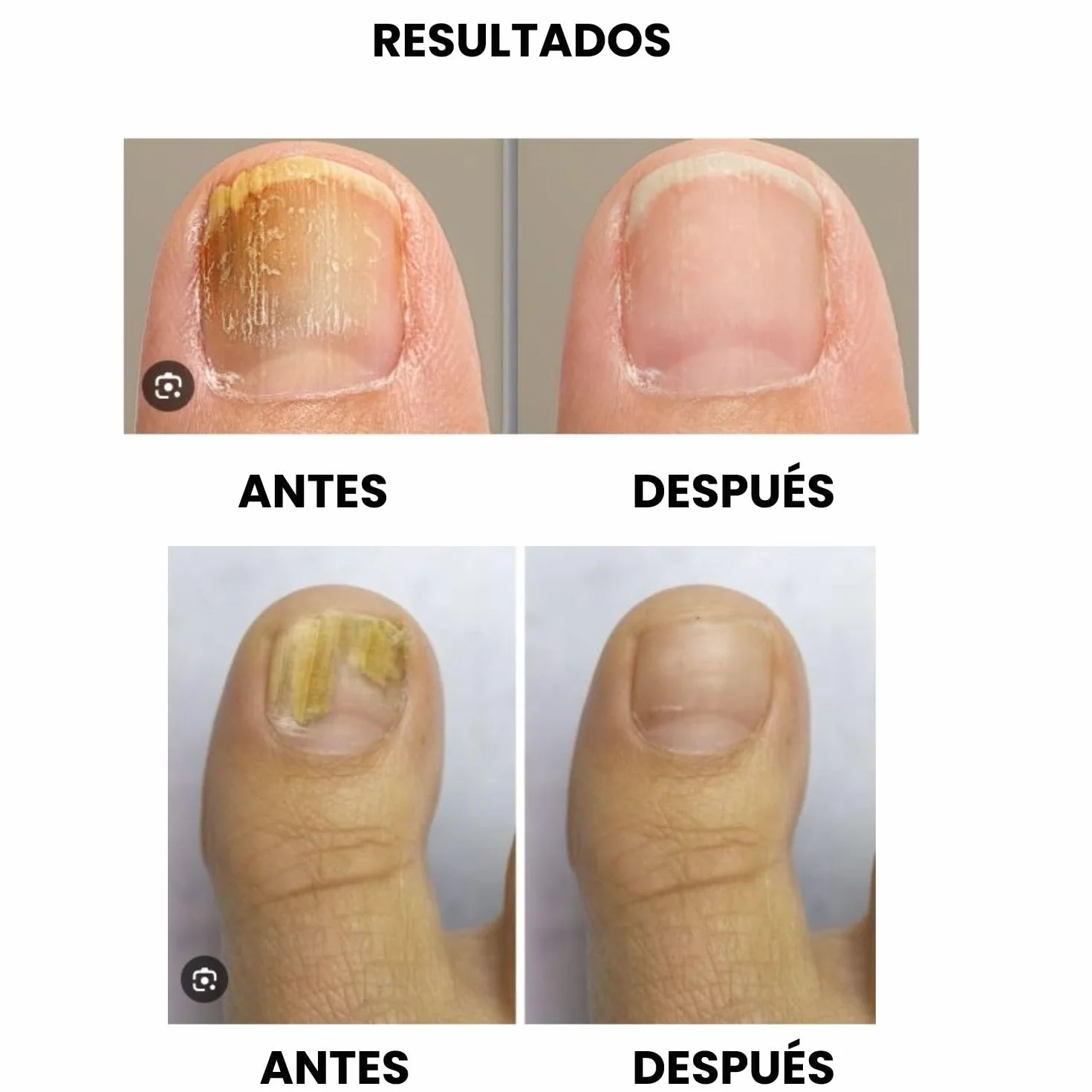 Tratamiento Hongos Uñas Pies Láser Onicomicosis Antifúngico Eliminar Micosis (Negro)