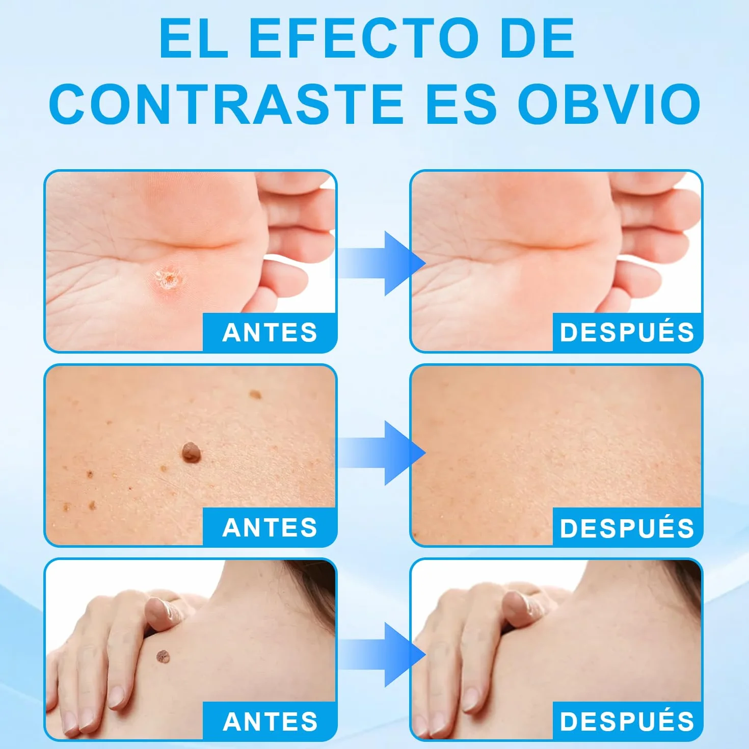 Removedor de verrugas de acción rápida - Lápiz con ácido salicílico y pincel de precisión (2.5ml)