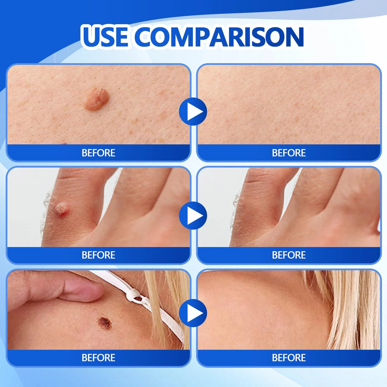 Líquido exfoliante para verrugas 30 ml cuidado piel áspera