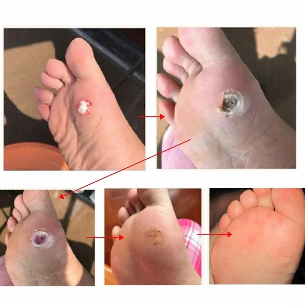 Almohadillas removedoras de callos para pies, 48 piezas, ácido salicílico, parche de verrugas plantares