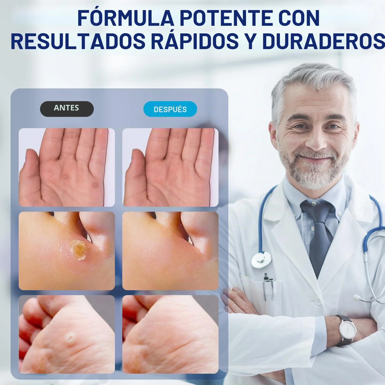 MYMULIKE Wart Remover 15 ml Solución para Callos y Verrugas