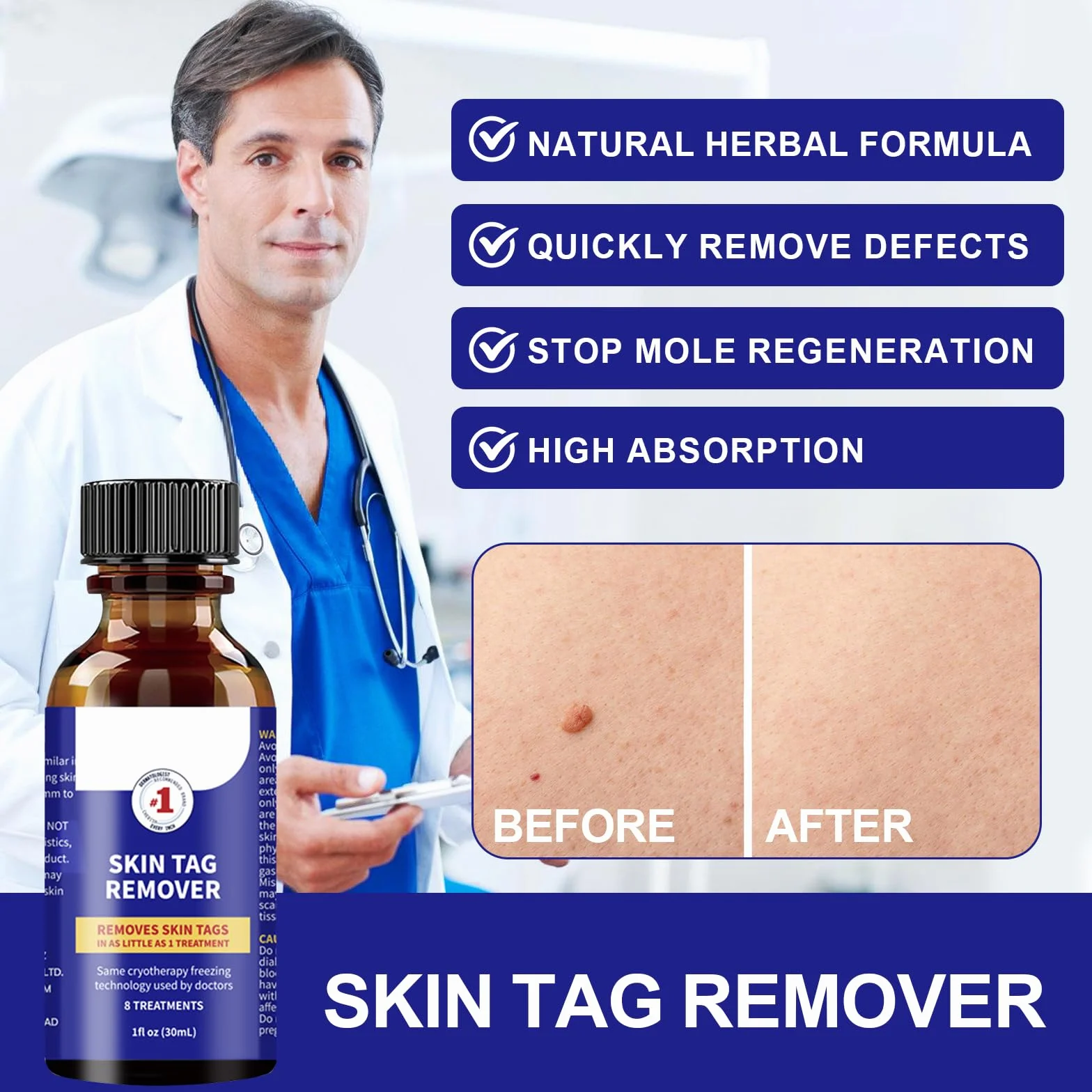 Suavemente Skin Tag Remover 30ml Quitar Verrugas Comunes Fórmula Suave