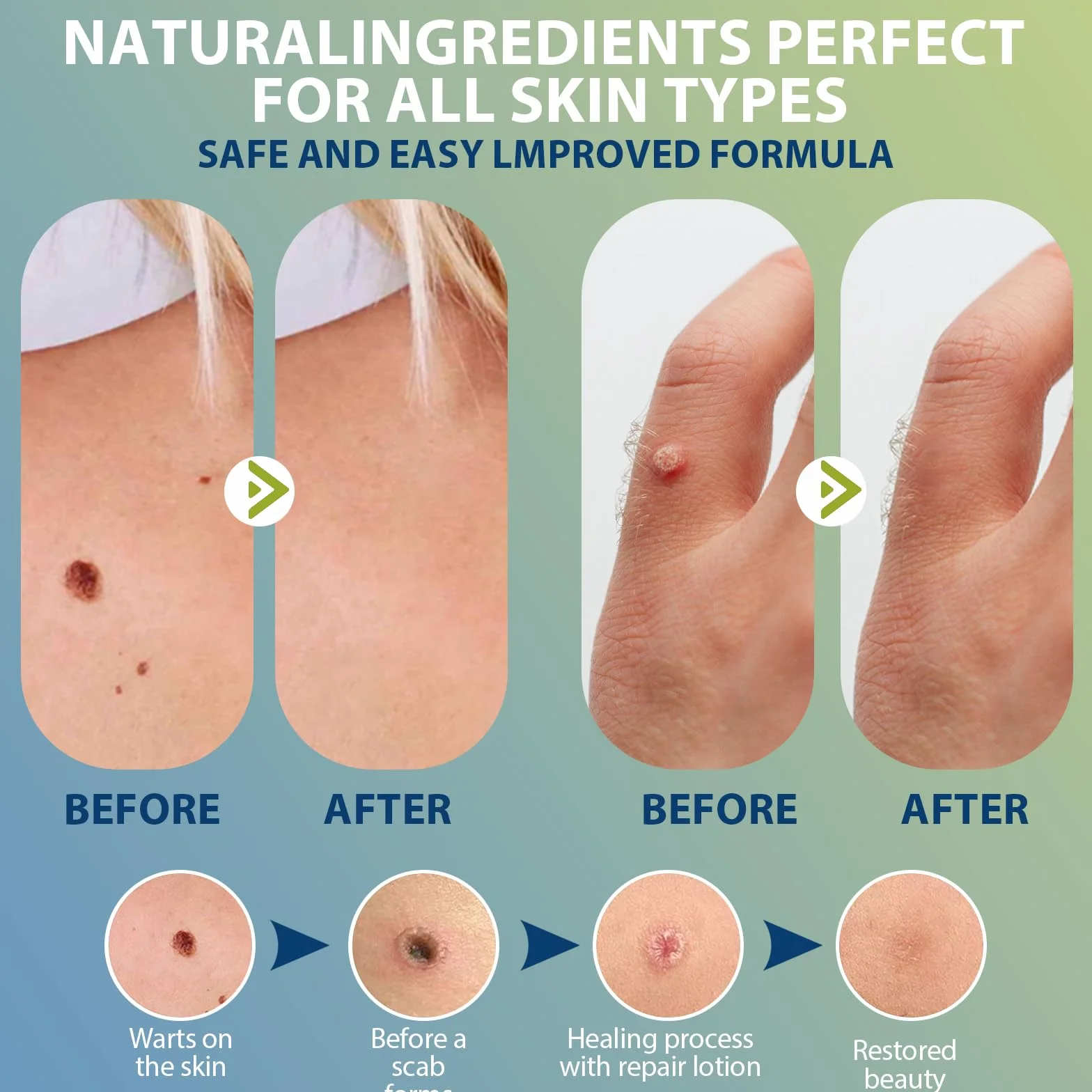 Lápiz de verrugas 5ml, Solución para el cuidado de la piel, para manos y pies