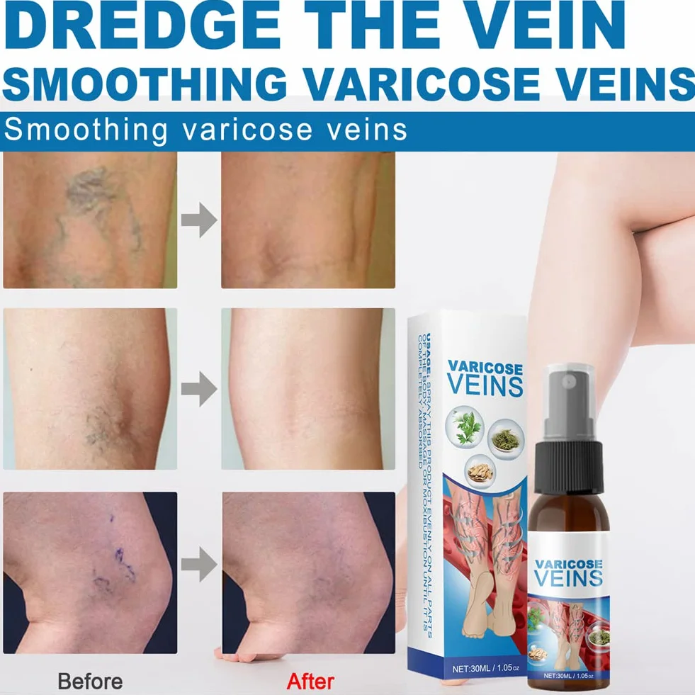 Spray Calmante para Venas Varicosas, Tratamiento de Varices, Alivio Dolor Pierna Circulación Sanguínea