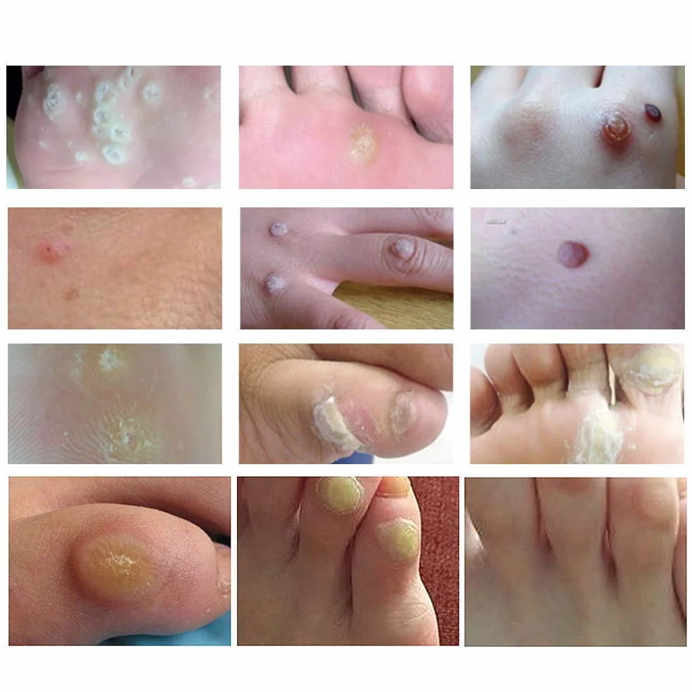 Removedor De Verruga En Pies Y Manos, Quita Verrugas Parches, 20 Piezas